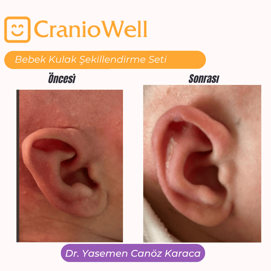 Pointed (Stahl’s) ear in a newborn before and after ear molding