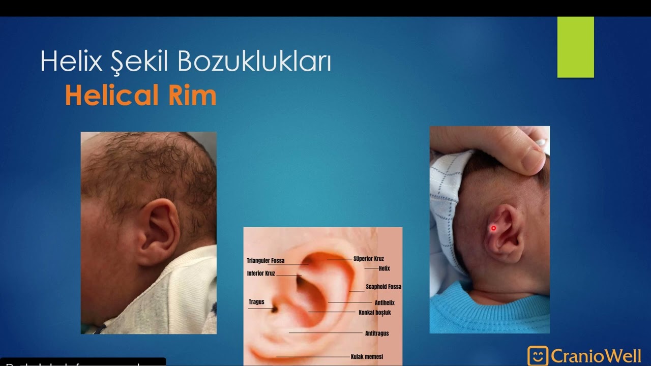 Helical rim deformity in a newborn ear and the parts of the outer ear