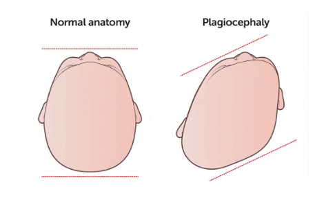 plagiosefali (1).png