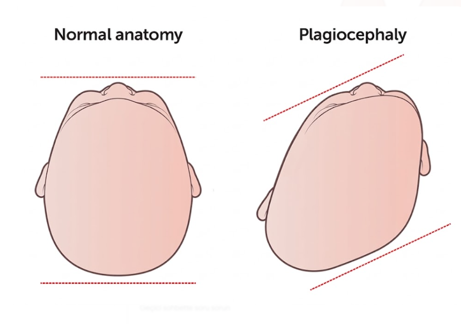 plagiosefali (2).png
